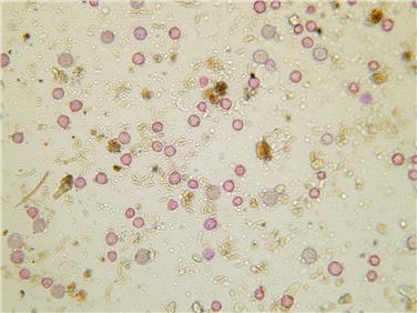 Blick durchs Mikroskop - Luftprobe von Schlanders am 2. April mit gefärbten Birken-Pollen zwischen Pilzsporen und Sahara-Staub: An diesem Tag erreichte allein die Birke eine Rekord-Pollenkonzentration von 1115 Pollen pro Kubikmeter Luft.
